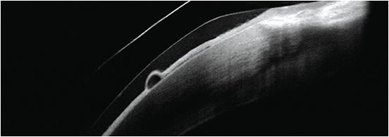 FIGURE 2. Small epithelial bulla secondary to corneal hypoxia from scleral lens wear.Photo courtesy of Roxana Hemmati, OD