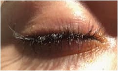 Figure 1. Eyelash trichomegaly interfered with this patient’s lid closure.