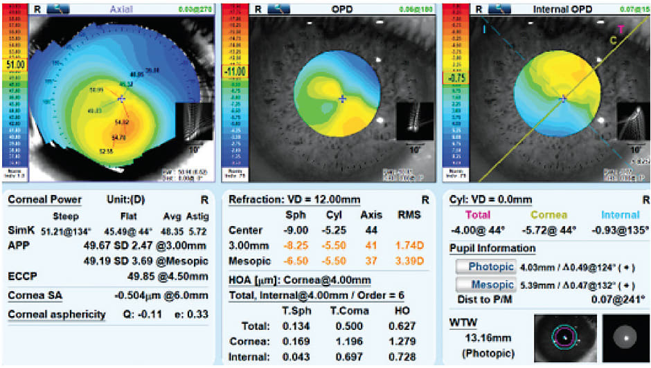 FIGURE 1. Large oval keratoconus right eye.