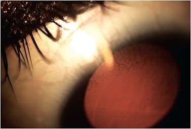 Figure 3. While hydrogel lenses are safe for daily wear for most patients, those who have higher prescriptions should be monitored for hypoxia-related complications, such as vascularization from wear of this high-minus lens.