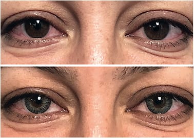 Figure 9. A patient wanted to have lighter-colored eyes without the obvious appearance of wearing colored contact lenses. Taking into consideration her dark brown eyes and hair, a gray opaque cosmetic contact lens was used to create the look the patient desired.