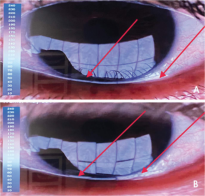 Figure 1. (A) Reflection of the lower tear meniscus area prior to the blink (red arrows). (B) The lower tear meniscus area widens as the lower lid margin begins to fold outward with the start of the blink (red arrows). A video of this patient’s blink is available below.