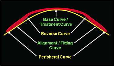Figure 1. Depiction of described ortho-k lens curves from inside out.
Courtesy of Patrick Caroline