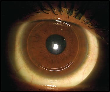 Figure 5. For normal corneal shapes, the hybrid lens GP center should be fit as close to alignment as possible.