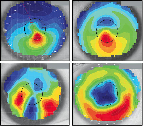 Figure 2. Irregular corneas. Upper left: keratoconus; upper right: keratoconus with inferior intracorneal ring segment; lower left: corneal graft; lower right: radial keratotomy.