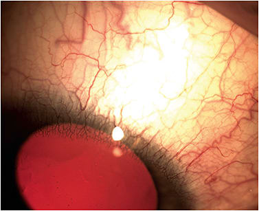 Figure 1. An example of vascularization resulting from wear of low-Dk contact lenses.