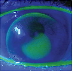 Figure 1. The patient’s original corneal GP lens was very steep, with resulting inferior decentration and edge seal-off.