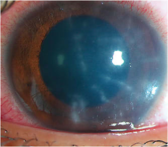 Figure 2. This patient with radial epithelial perineuritis was diagnosed with bilateral Acanthamoeba keratitis that developed after rinsing their orthokeratology lenses with tap water. Photo courtesy of the Francis I. Proctor Foundation/UCSF.