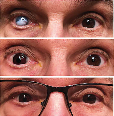 Figure 2. Patient who has leukoma fit with a dark brown translucent tinted lens with a black pupil. His glasses further enhance the cosmetic match.