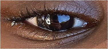 Figure 4. Corneal GP lenses with center-distance multifocal optics can be fitted for myopia management.