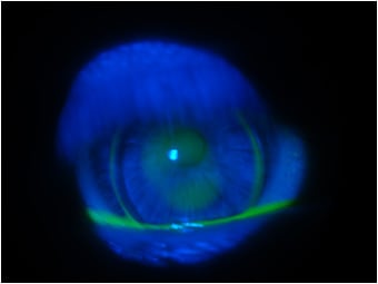 Figure 2. Mild apical touch below the pupil during blinking (OD).