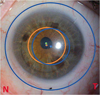 Figure 3. The scleral lens (outlined by the large blue ring) typically decenters inferior temporal on the eye, resulting in optical zone decentration (smaller blue ring) and off-pupil positioning of the lens optical axis (blue spot). The orange ring represents the optical zone decentered with respect to the overall lens diameter, allowing a closer match of the optical axis of the lens (orange spot) to the visual axis (green spot).Image courtesy of Gonzalo Carracedo, PhD.