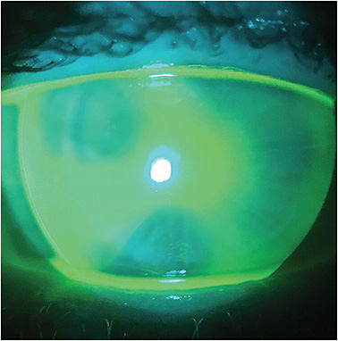 Figure 6. An intracorneal lens on an eye that has undergone radial keratotomy.