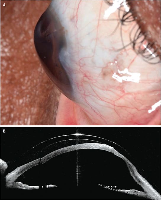 Fitting a scleral lens in a case with decentered ectasia. This is a very rare case of a pellucid marginal degeneration decentered superiorly. (A) A profile view of the cornea. (B) An OCT image showing the scleral lens applied to the eye. It can be observed that the lens is touching the corneal apex while having an excessive clearance in the opposite area. By increasing the lens vault to clear the apex, the clearance in the opposite area will further increase, creating more fitting issues.