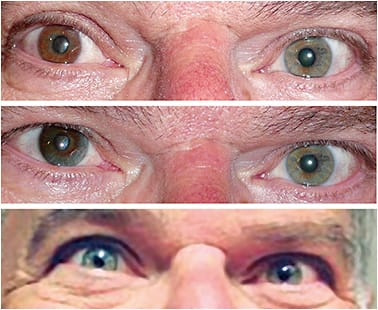 Figure 6. A patient who has iris heterochromia (top) was fit with a hand-painted prosthetic lens for his right eye. After one year of part-time wear, the opaque backing and color began to fade, and the natural iris detail was visible through the contact lens (middle). Because the patient had light eyes with unique coloration, making a new hand-painted contact lens was the best option for a favorable color match (bottom).