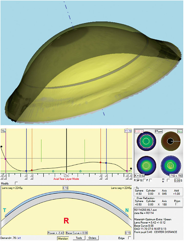 Figure 2. Software simulation demonstrating empirically designed lenses on ocular surfaces created from measured topography.