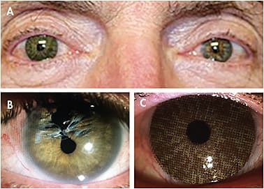 Figure 2. Examples of a print-transfer soft ocular prosthetic contact lens. 2B shows an eye without a lens that has been injured from a projectile. 2C shows a printed lens on the same eye that has a closed pupil.