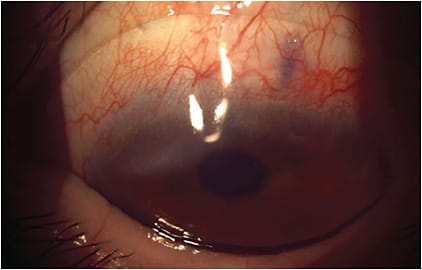 FIGURE 4. Final impression-based OS lens demonstrating alignment over the superior temporal tube shunt. Photo courtesy of Roxana Hemmati, OD