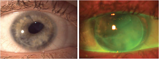 FIGURE 12. Anterior segment photos (without and with sodium fluorescein for better visibility) demonstrating a soft lens used as a piggyback for comfort OD. Photo courtesy of Sheila Morrison, OD