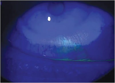 FIGURE 1. Anterior ocular staining following poor lens-handling technique.Photo courtesy of Menicon.