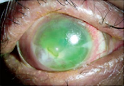 FIGURE 6. Persistent epithelial defect observed in the cornea under a scleral lens. Photo courtesy of Gloria Chiu, OD.