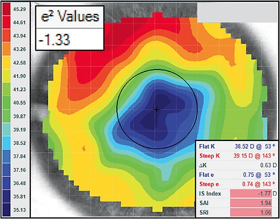 Figure 6. A post-radial keratotomy cornea that has a highly oblate shape.