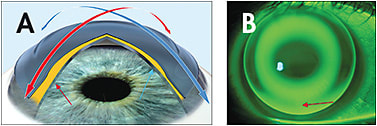 Figure 3. (A) Different corneal shape between the flat and steep meridians results in incomplete alignment along the steep axis (red). A spherical lens on this eye fails to seal off 360º with the alignment curve. Notice the greater space between the cornea and back lens surface at the smaller red arrow compared to the blue. (B) This results in greater fluorescein pooling and leakage. A meridian-specific design would equally distribute the alignment curve. 
Courtesy of Ken Kopp