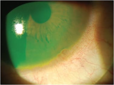 Figure 2. Scleral lenses are an important part of any specialty contact lens practice. Pictured is a slightly larger-than-needed lens with excessive limbal clearance and inferior conjunctival prolapse.