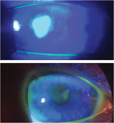 Figure 1. (top) Patient from Case #1 before amniotic membrane and (bottom) after amniotic membrane.