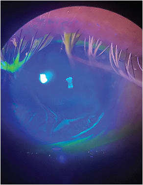 Limbal stem cell deficiency in a glaucoma patient who has been treated with preservative-containing glaucoma drops for several decades.