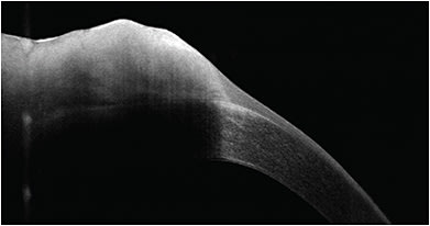 FIGURE 2: OCT showed a thickened hyperreflective epithelium with an abrupt transition from normal epithelium. IMAGE COURTESY BEERAN MEGHPARA, MD