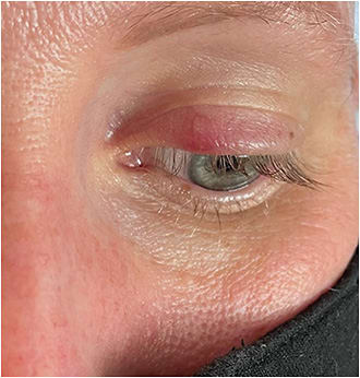 FIGURE 1: Ocular and facial rosacea with acute hordeolum in a 38-year-old woman. IMAGE COURTESY LAURA M. PERIMAN, MD