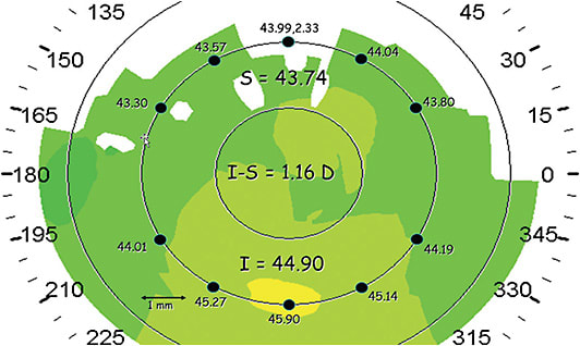 FIGURE 5: The I-S index is the dioptric power difference of the average of 5 points of the inferior map, and the dioptric average of five mirroring points of the superior map. IMAGE COURTESY STEVEN E. WILSON, MD