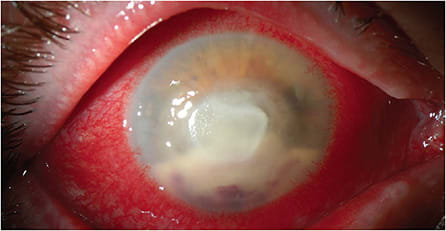 FIGURE 3. Presentation of Aspergillus previously treated with fortified antibacterial drops. Diagnosis required biopsy. IMAGE COURTESY SUMITRA KHANDELWAL, MD