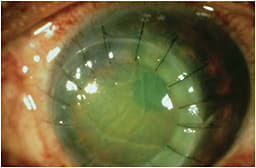 Tectonic, therapeutic corneal transplant.