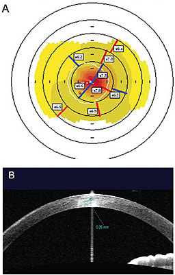 A) Postoperative keratometric map showing a central hyperprolate zone; B) Anterior segment OCT showing the PEARL lenticule that has been implanted.