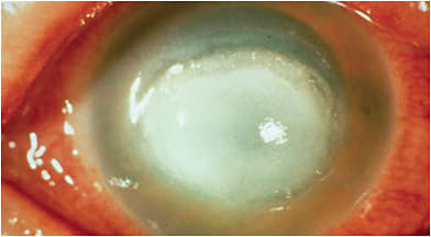 ACANTHAMOEBA KERATITIS: Classic, advanced ring infiltrate