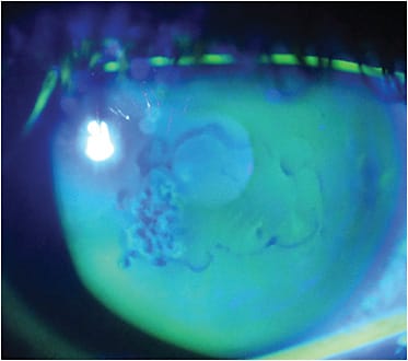 FIGURE 3: Note the negative staining pattern with fluorescein instilled under cobalt blue light.