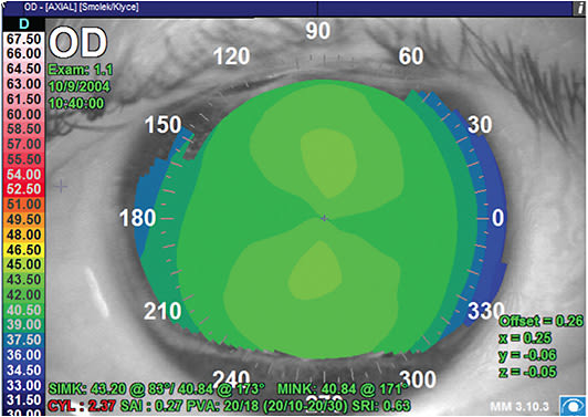 FIGURE 3: Example of corneal topographic astigmatism with the standard scale.