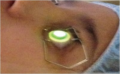 A patient undergoing the corneal cross-linking procedure. IMAGE COURTESY WILLIAM TRATTLER, MD