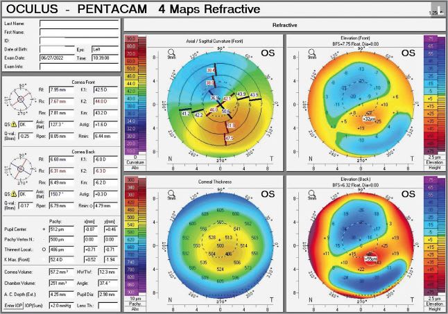 Patients with mild-to-moderate KCN, such as the patient illustrated here, may be candidates for TCAT. IMAGE COURTESY MARK LOBANOFF, MD.