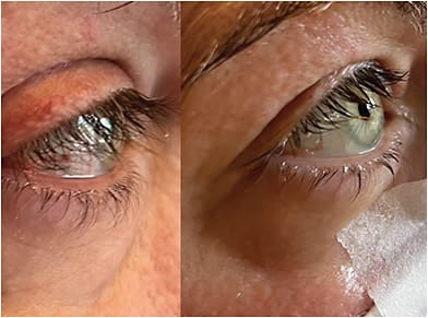 FIGURE 4: Improved eyelid erythema, redness, and lid position immediately following IPL and one drop of Upneeq (RVL Pharmaceuticals, Inc.). IMAGE COURTESY LAURA M. PERIMAN, MD