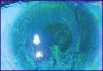 Figure 8. Stage 1 neurotrophic keratitis with diffuse punctate epitheliopathy.