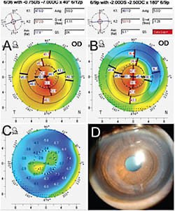 CAIRS (corneal allogenic intrastromal ring segments): Segments of de-epithelialized and de-endothelialized corneal stromal tissue are placed within femtosecond laser-dissected channels created in the midperipheral stroma of the keratoconic patient’s cornea, somewhat similar to synthetic intracorneal ring segments (ICRS). Visual acuity and refraction values are shown on the top of the figure. There is an improvement in UDVA from 6/36 (20/120) to 6/9p (20/32); an improvement in CDVA from 6/12p (20/50) to 6/9p (20/32); and a decrease in refractive cylinder from -7 DC to -2.50 DC postoperatively. A) Preimplantation keratometric map; B) Postimplantation keratometric map; C) Difference map showing overall flattening with steepening in 1 axis corresponding to the preoperatively flat axis. This flattening results in overall regularization of the topography and a decrease in cylinder and astigmatism; D) Postoperative slit-lamp image of the eye. (Dr. Jacob has a patent pending for the special trephines, devices, and processes used to create these segments, as well as for the CAIRS segments and various types of shaped and processed corneal segments.)