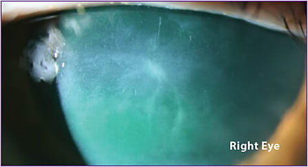 Figure 5. What appears to be an active dendrite is actually residual scarring within the corneal stroma after multiple episodes of HSV keratitis through the years.