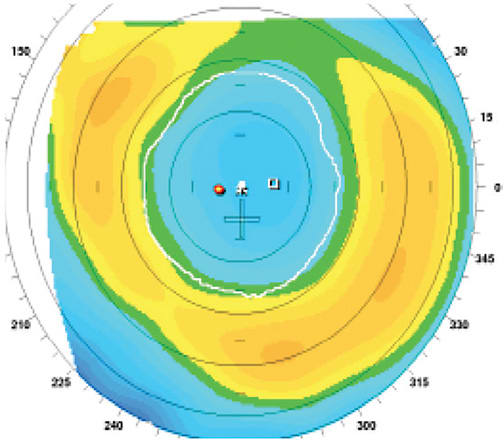 FIGURE 3: The steep transition zone created significant glare. IMAGE COURTESY MARK LOBANOFF, MD