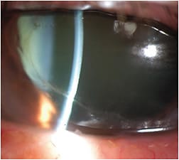 FIGURE 2: PUK secondary to RA. IMAGE COURTESY HELEN K. WU, MD