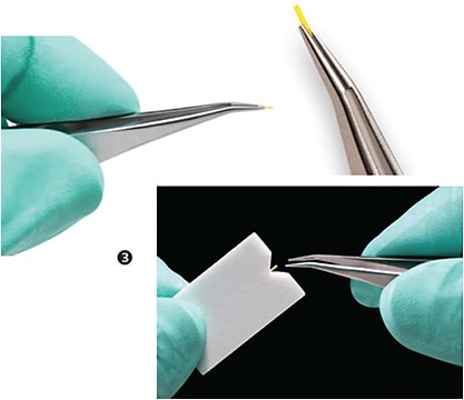 DEXTENZA® (dexamethasone ophthalmic insert) for intracanalicular use, shown in surgical forcep.