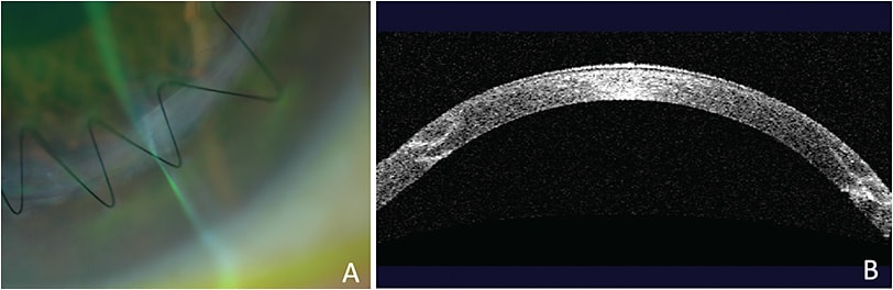 FIGURE 2: A: Slit-lamp photo of “zig-zag” incision. B: Anterior segment OCT of “zig-zag”PHOTO CREDITED: GARG S., ECHEGOYEN J., FARID M., WADE M., STEINERT R.F. (2014) LASER-ASSISTED KERATOPLASTY AND POST-KERATOPLASTY MANAGEMENT. IN: JENG B. (EDS) ADVANCES IN MEDICAL AND SURGICAL CORNEA. ESSENTIALS IN OPHTHALMOLOGY. SPRINGER, BERLIN, HEIDELBERG.