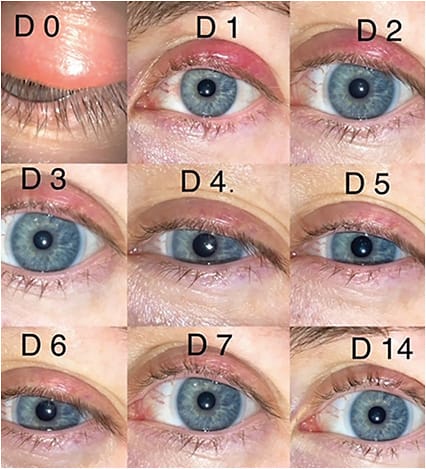 FIGURE 5: Improvements in appearance of chalazion after one session of IPL treatment. IMAGE COURTESY LAURA M. PERIMAN, MD